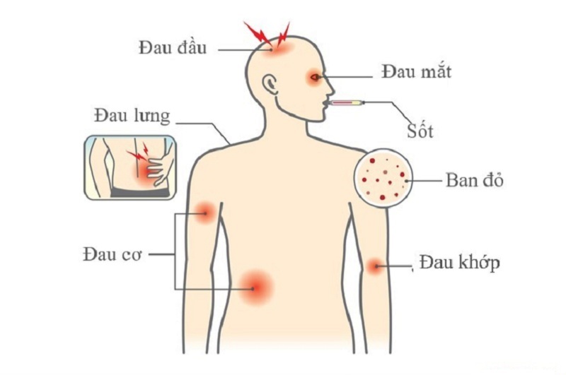 Những triệu chứng của bệnh sốt xuất huyết ở người lớn