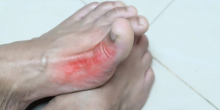 Người bệnh Gout thường xuất hiện viêm, tấy đỏ ở khớp