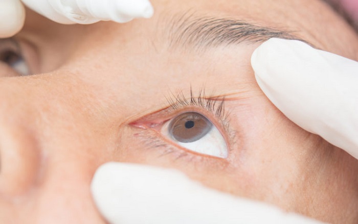 Dùng kháng sinh dưới dạng nhỏ mắt để điều trị tại chỗ