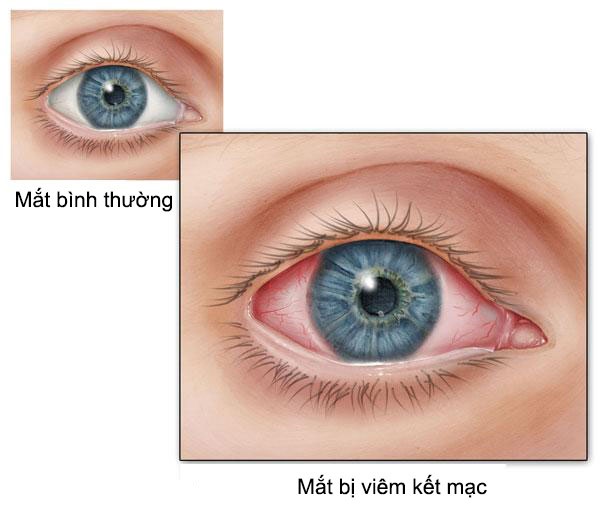 Mắt bình thường và mắt bị viêm kết mạc