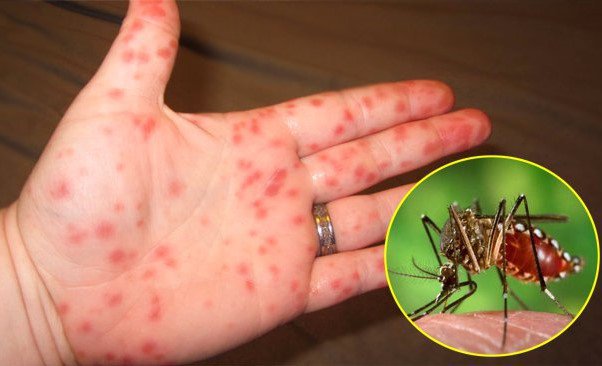 Xuất hiện nốt ban dỏ dưới da trong bệnh sốt xuất huyết ơt người lớn
