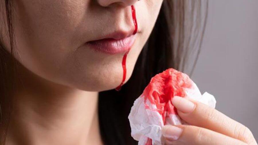 Chảy máu cam thường chỉ xảy ra ở một bên mũi và chỉ kéo dài trong vài phút