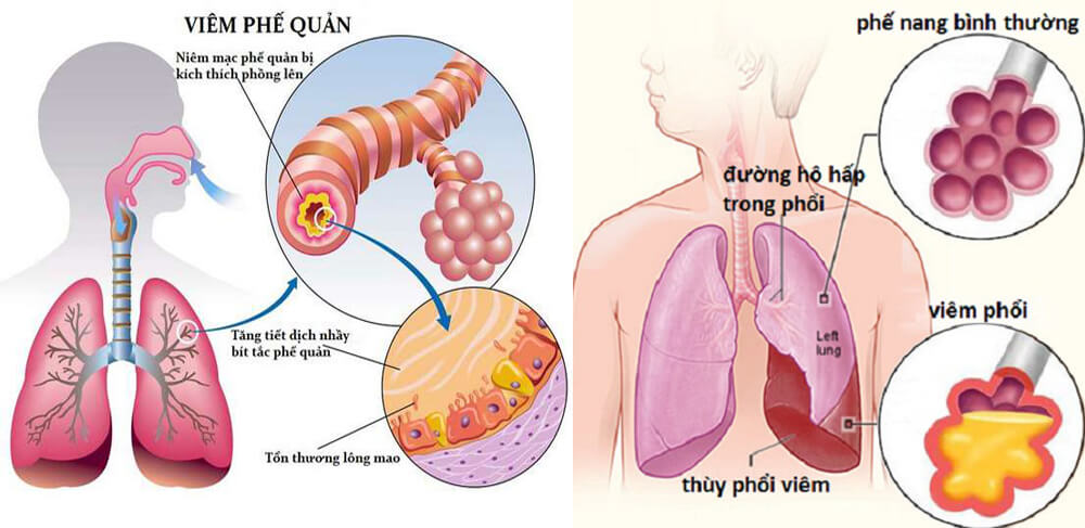 Phân biệt giữa viêm phế quản và viêm phổi