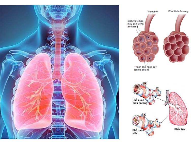 Viêm phế quản và viêm phổi có điểm gì khác nhau?
