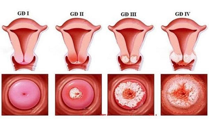 Ung thư cổ tử cung được chia thành 4 giai đoạn