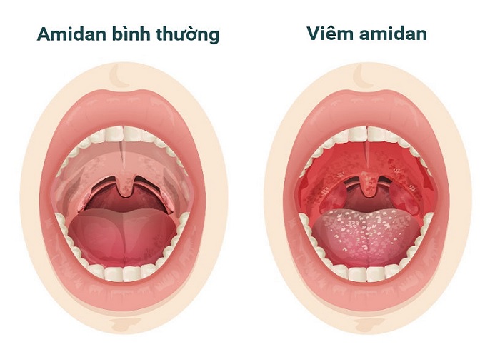 Viêm Amidan gây đau rát ở họng