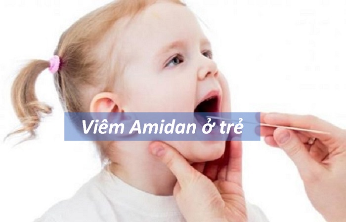 Viêm Amidan là một bệnh lý đường hô hấp phổ biến