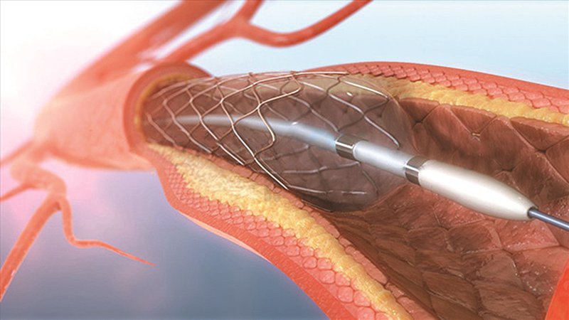 Đặt stent động mạch phòng biến chứng xơ vữa động mạch