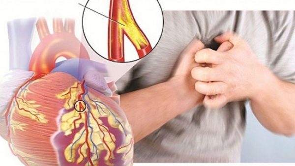 Xơ vữa động mạch có nguy hiểm không?