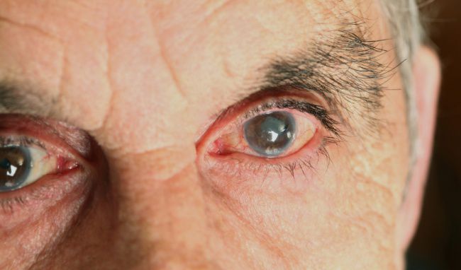 Tầm nhìn của mắt người bị đục thủy tinh thể suy giảm