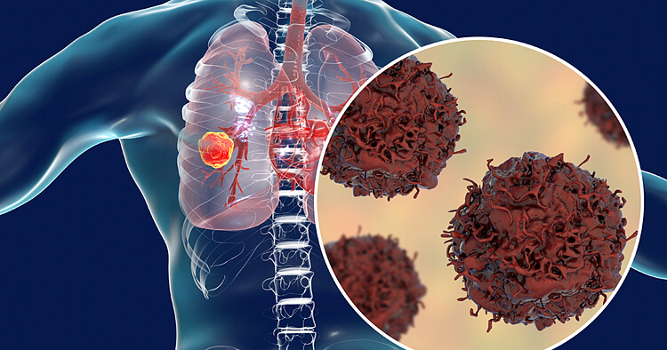Ho khan là một trong những triệu chứng của ung thư phổi