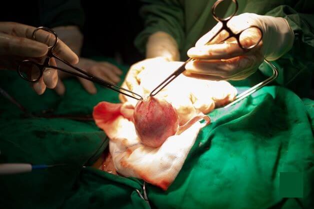 Phẫu thuật bóc u xơ tử cung