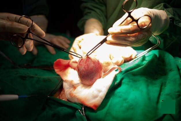 Phẫu thuật bóc tách u xơ tử cung