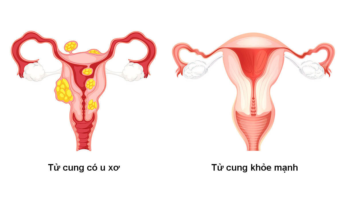 Hình ảnh tử cung bình thường và tử cung có u xơ