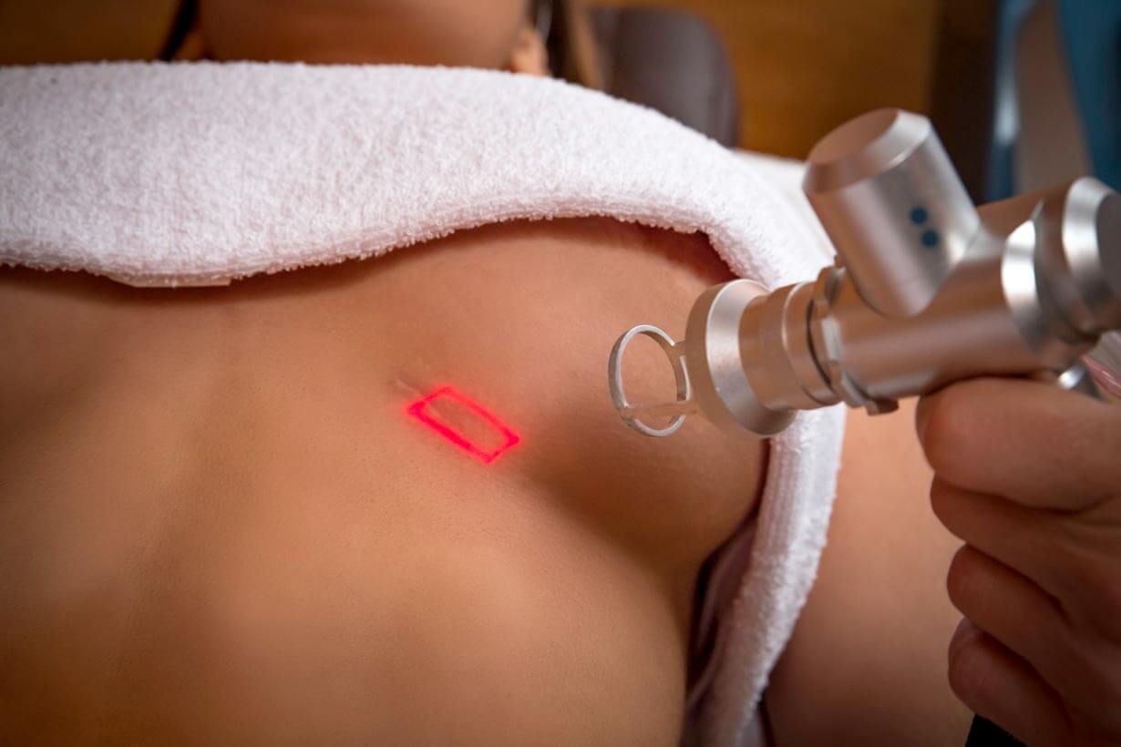 Laser giúp điều trị sẹo lồi