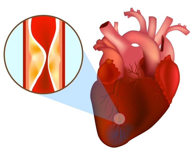 Nhồi máu cơ tim do lòng mạch bị tắc bởi các mảng xơ vữa