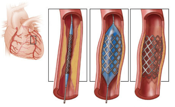 Thủ thuật đặt ống thông (stent) vào mạch máu bị tắc