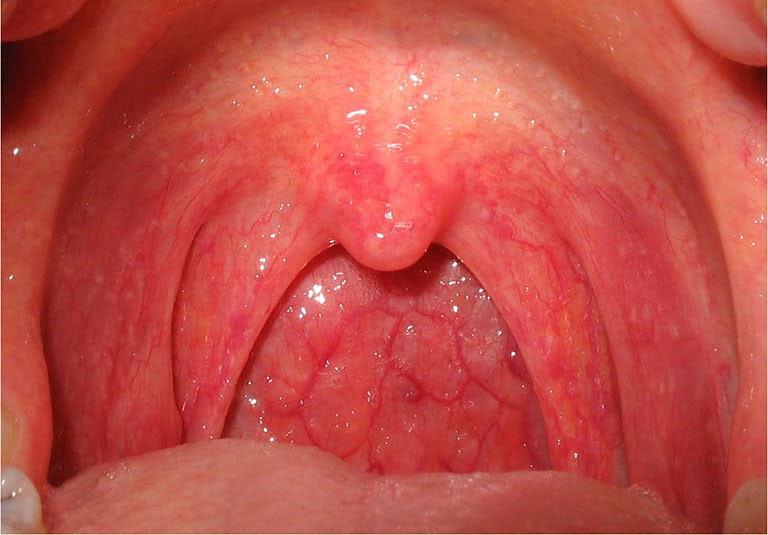 Cổ họng sưng đỏ - dấu hiệu viêm họng ở trẻ sơ sinh