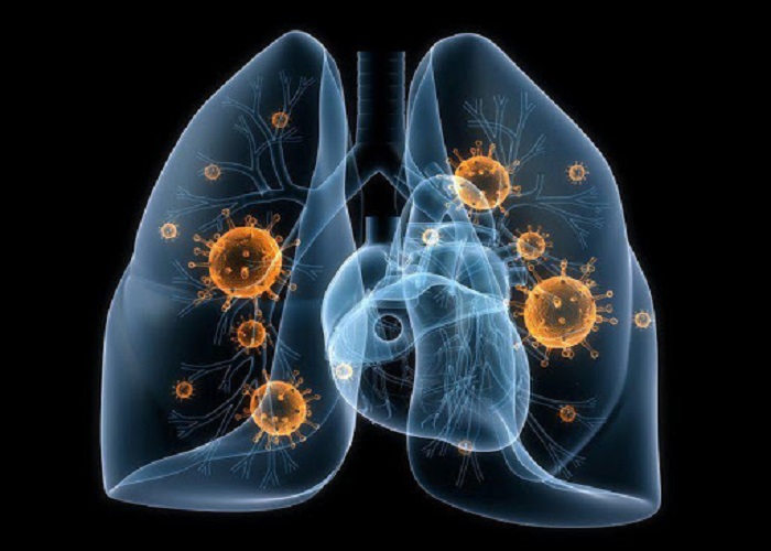 Bệnh viêm phổi là gì? Nguyên nhân gây bệnh
