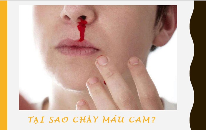 Chảy máu cam xảy ra khi các mạch máu trong mũi bị tổn thương