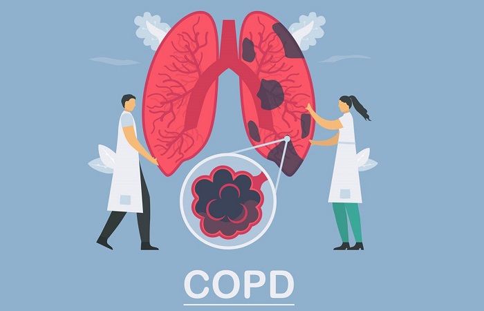 Bệnh phổi tắc nghẽn mạn tính (COPD) là bệnh hô hấp phổ biến