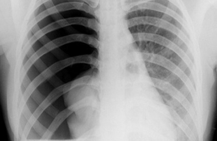 Tràn khí màng phổi là biến chứng do COPD gây ra