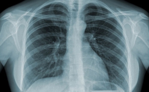 Có thể chụp Xquang để chẩn đoán COPD và các biến chứng của bệnh