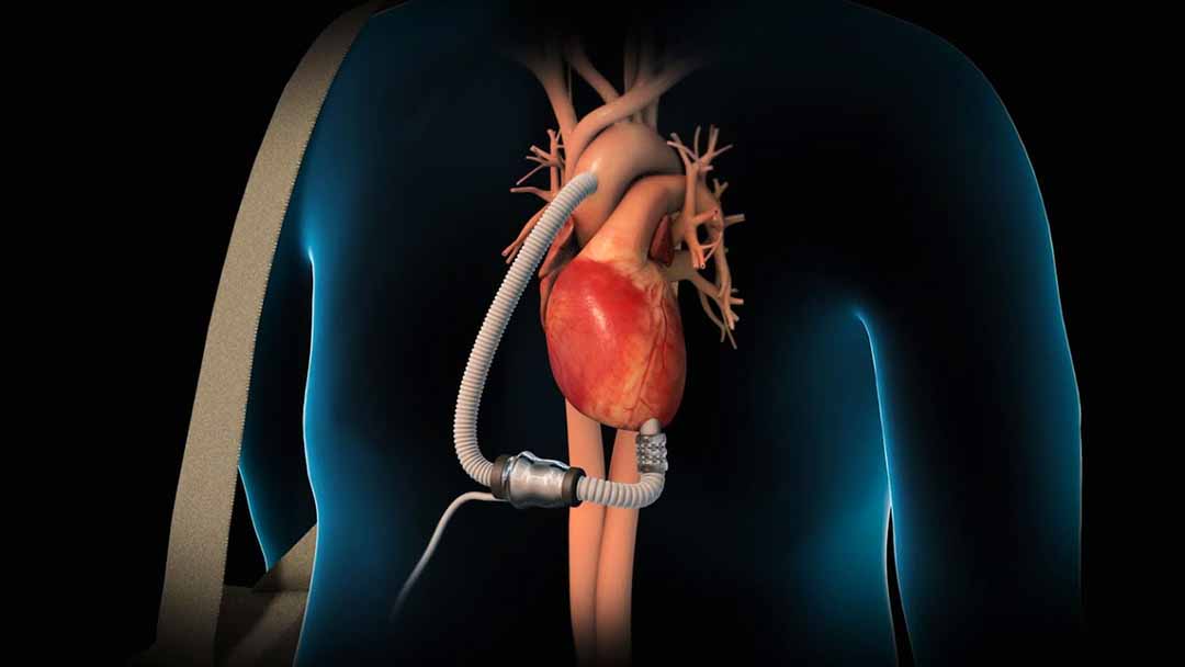 Thiết bị VAD giúp tim hoạt động bình thường