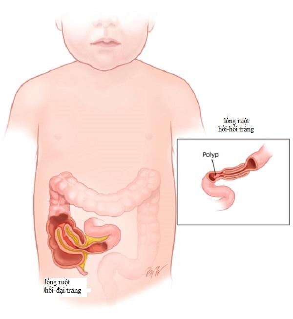 Nguyên nhân lồng ruột ở trẻ có thể do polyp, khối u