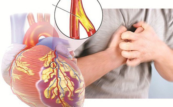 Một trong biến chứng nghiêm trọng của thiếu máu cơ tim là đau tim