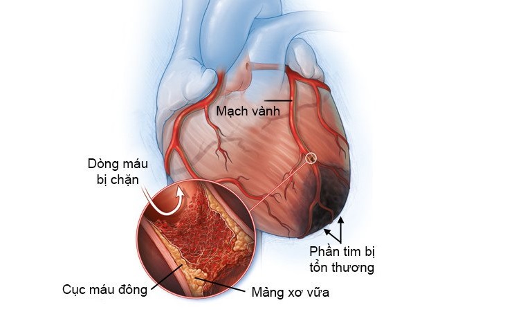 Nguyên nhân gây thiếu máu cơ tim là cục máu đông, mảng xơ vữa