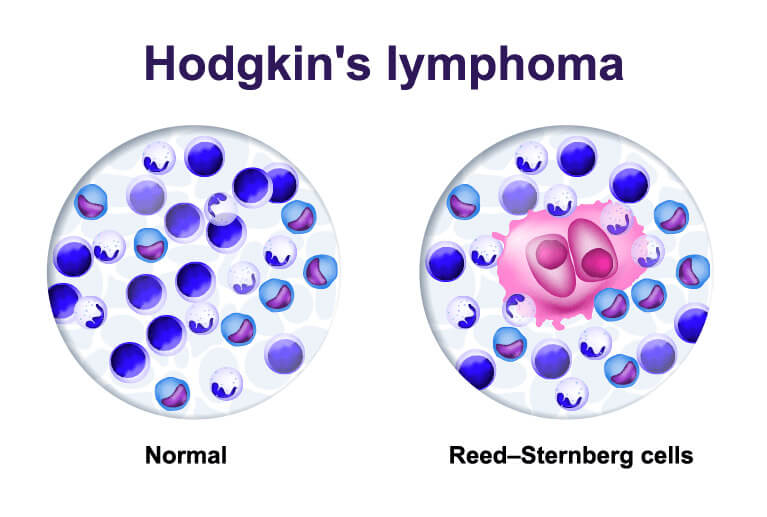 Tế bào Reed-Sternberg trong u lympho Hodgkin