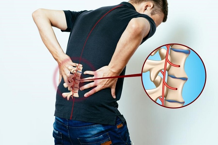 Viêm cột sống dính khớp thường gây đau âm ỉ, kéo dài ở vùng lưng, thắt lưng
