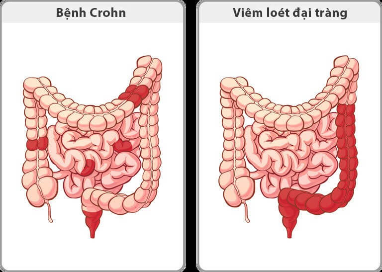 Bệnh Crohn và viêm loét đại tràng