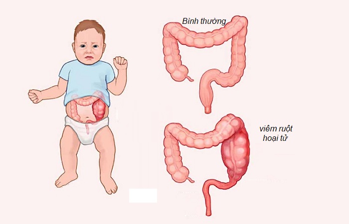 Viêm ruột hoại tử thường gặp ở trẻ sơ sinh