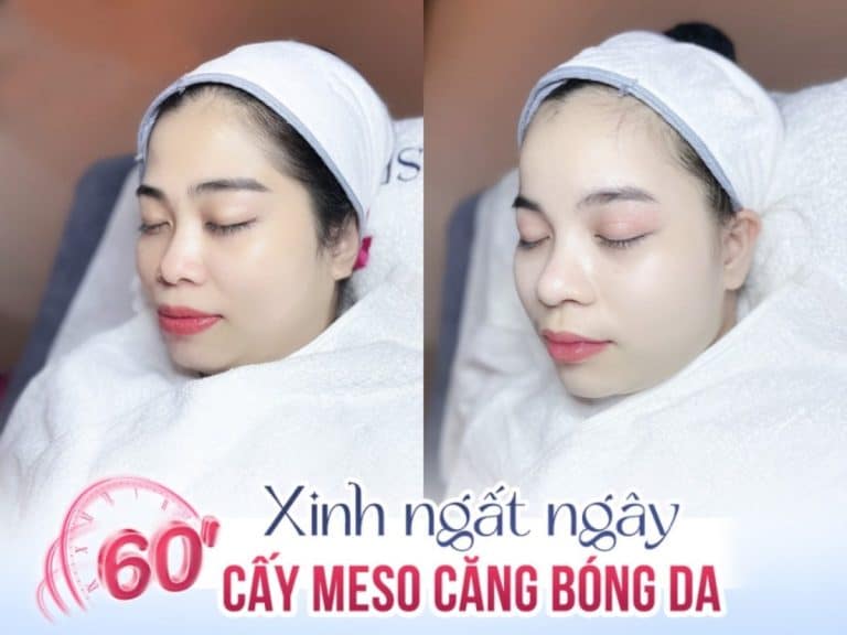 Căng da mặt bằng meso có giá chỉ từ 5.5 triệu đồng