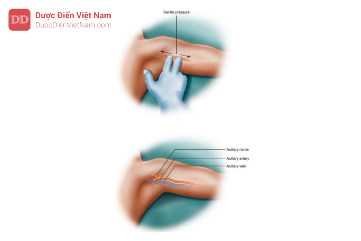 Hình 10. Vị trí giải phẫu của động mạch nách. Động mạch nách là sự tiếp nối của động mạch dưới đòn sau khi nó đi qua xương sườn thứ nhất. Vị trí của động mạch nách có thể sâu tới bề mặt da, nhưng ưu điểm của động mạch này là tương đối dễ bắt mạch. Vị trí của cánh tay nên dạng ra và xoay ra ngoài