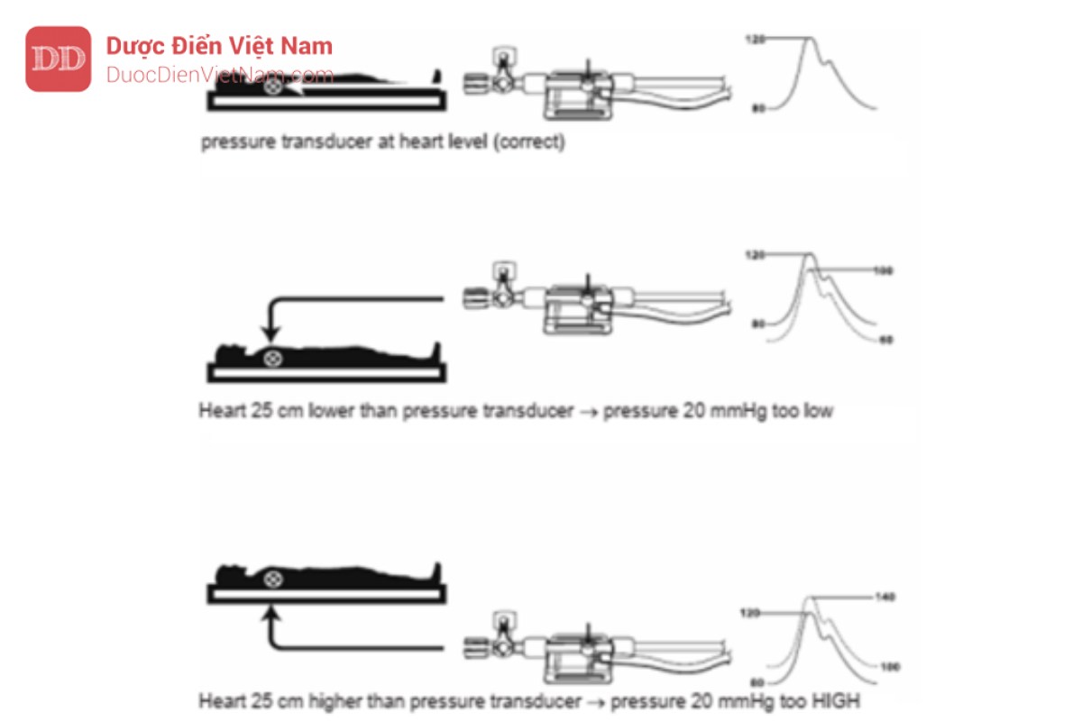 Hình 14. Các kết quả đo huyết áp khác nhau tùy thuộc vào vị trí của đầu chuyển đổi áp lực: Nếu đầu transducer áp suất nằm ở trên mức tim – mức đường nách giữa, giá trị huyết áp ước tính thấp dưới mức so thực tế. Nếu đầu transducer nằm dưới mức tim, giá trị huyết áp ước tính cao quá mức so thực tế.