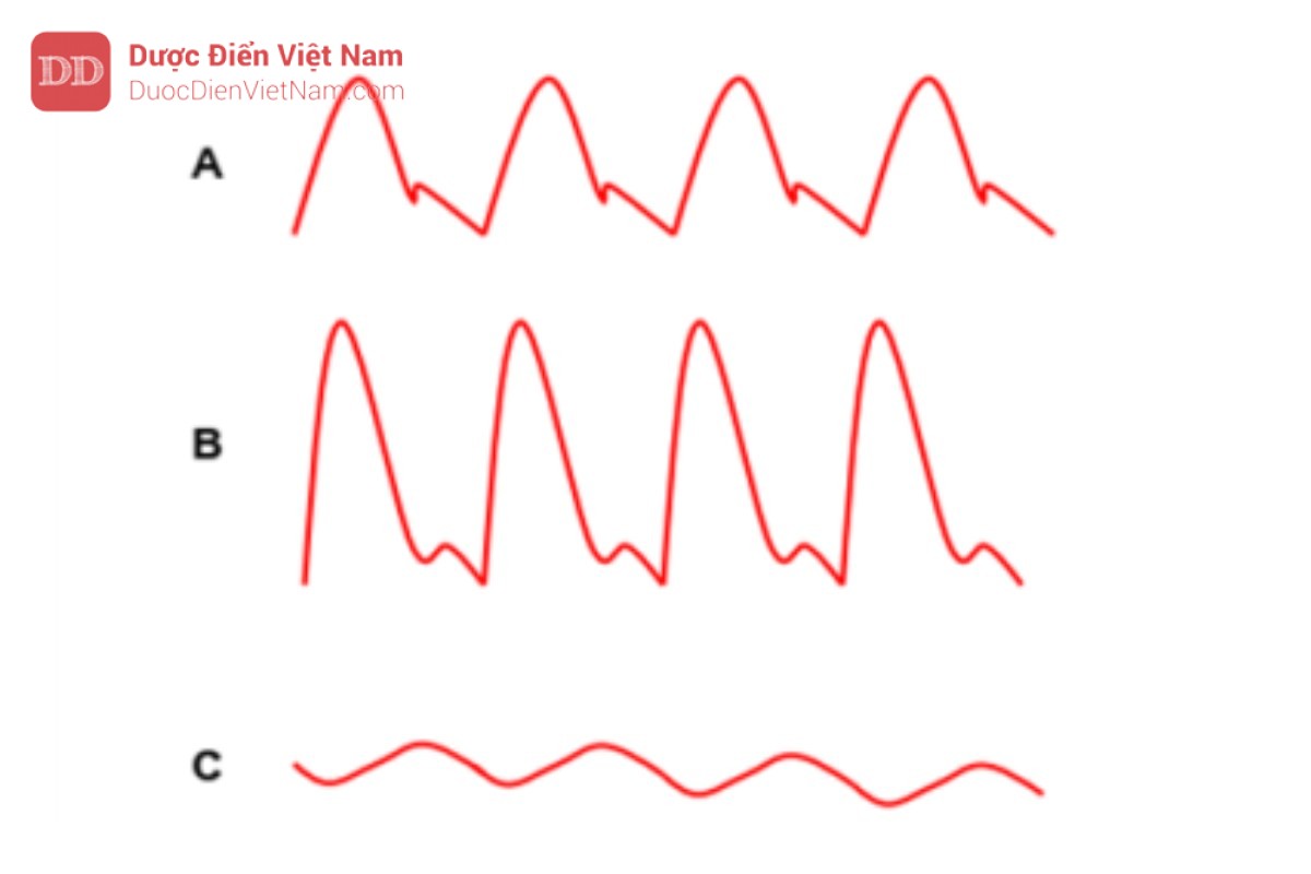 Hình 15. A: giảm chấn bình thường; B: giảm chấn dưới mức (biên độ quá cao, đỉnh nhọn); C: giảm chấn quá mức (biên độ quá thấp, đỉnh tròn).