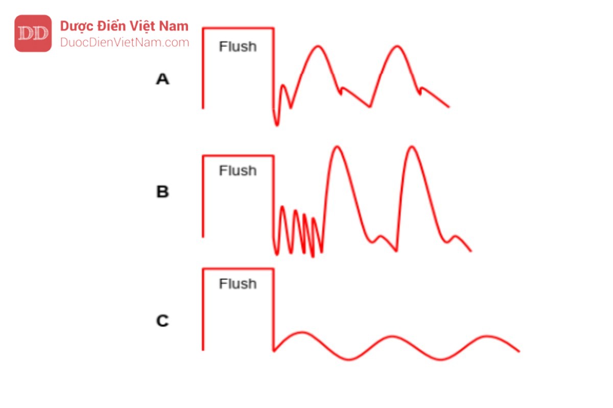 Hình 16. Để kiểm tra xem hệ thống có được giảm chấn chính xác hay không, quá trình kiểm tra bằng Test xả nước được thực hiện và giai đoạn suy giảm (sau khi dừng xả, dao động trở về đường cơ sở) được quan sát. Trong giảm chấn thông thường (A) bạn chỉ có một dao động trong giai đoạn suy giảm, trong giảm chấn dưới mức (B) có một số dao động trong giai đoạn suy giảm và trong giảm chấn dưới mức (C) bạn không thấy dao động trong giai đoạn giảm dần.