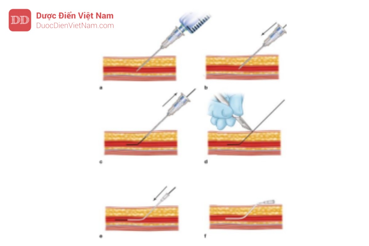 Hình 2. Kỹ thuật Seldinger để đặt catheter động mạch. Việc đặt catheter động mạch đùicó thể được thực hiện dễ dàng hơn bằng cách sử dụng kỹ thuật Seldinger. (a) Kim được đâm vào động mạch. (b) Rút ống tiêm ra khỏi kim để máu bắn trở lại thành dòng tia (để xác nhận vào động mạch). Đưa dây dẫn qua đốc kim và vào động mạch. (c) Tháo kim qua dây dẫn trong khi vẫn để dây dẫn tại chỗ. (d) Nếu cần để tạo điều kiện thuận lợi cho việc đưa catheter vào dễ dàng, có thể dùng lưỡi dao mổ đâm thủng da. (e) Đưa catheter qua dây dẫn và vào động mạch. (f) Tháo dây dẫn.