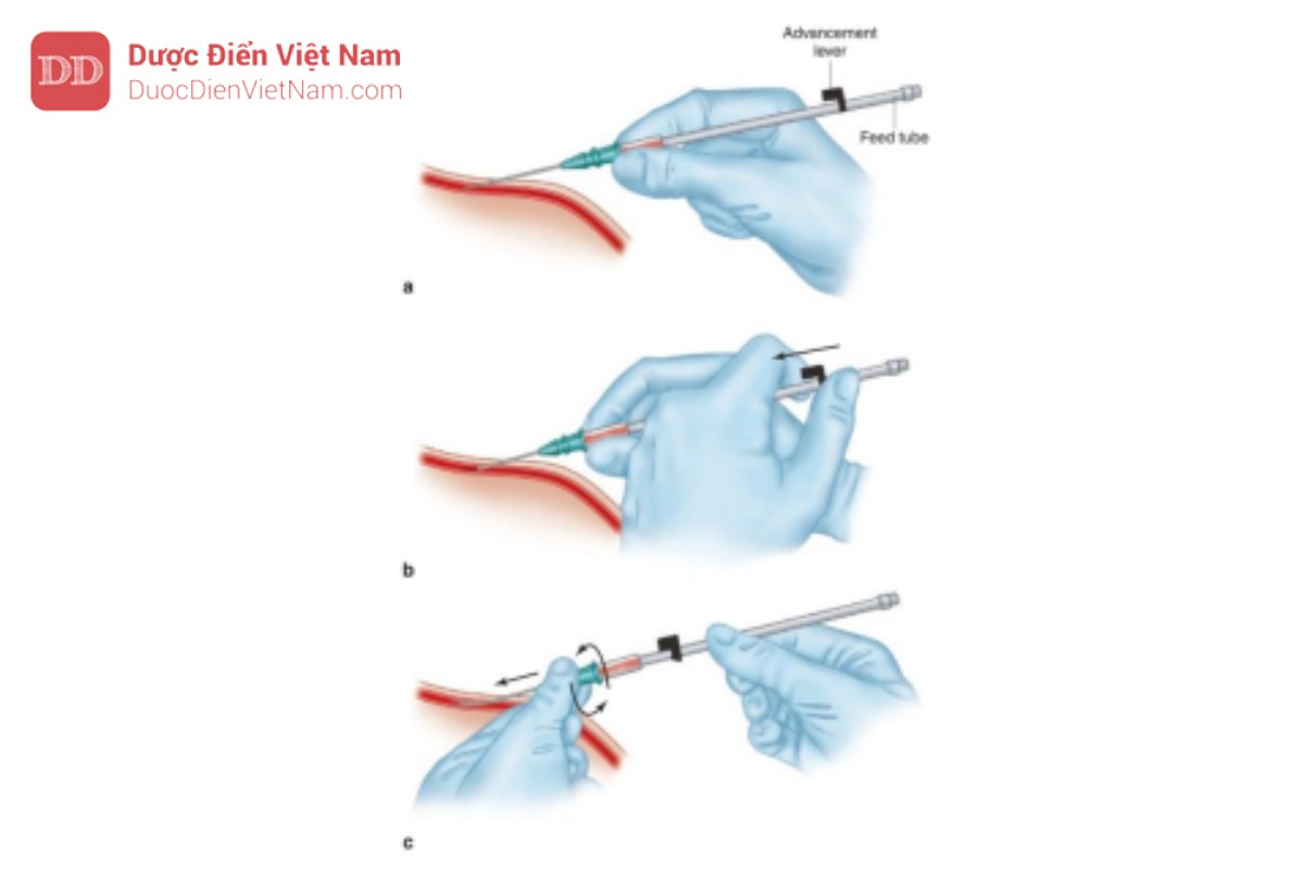 Hình 3. Đặt catheter động mạch quay: Kỹ thuật Seldinger với catheter – kỹ thuật qua dây.Bộ dụng cụ có bán trên thị trường bao gồm một catheter sử dụng một lần được đóng gói sẵn trên dây dẫn. (a) Vị trí đâm vào ở góc 30°–45° so với da và đưa vào động mạch. (b) Tiếp theo đưa dây dẫn qua kim và vào động mạch. (c) Cuối cùng đưa catheter qua dây dẫn vào động mạch bằng một động tác xoay nhẹ nhàng