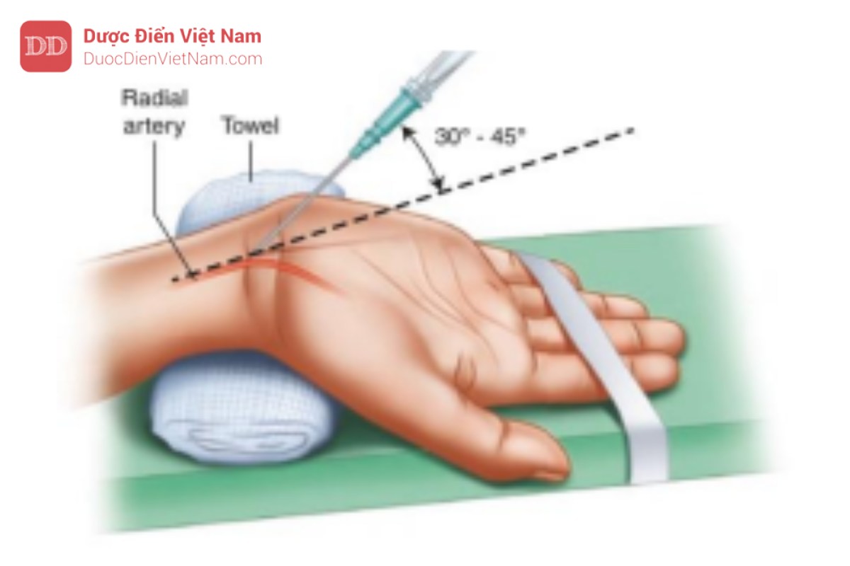 catheter-dong-mach