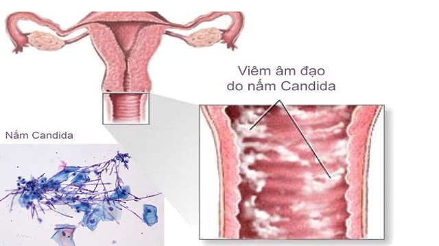 Nấm Candida gây viêm âm đạo