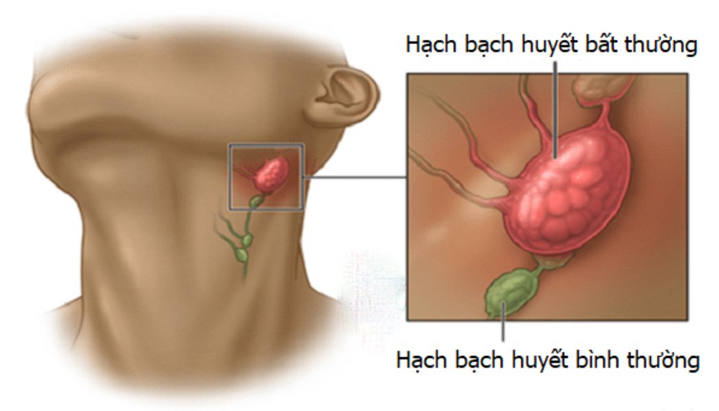 Sưng hạch, nổi hạch là một trong những cảnh báo quan trọng về sức khỏe