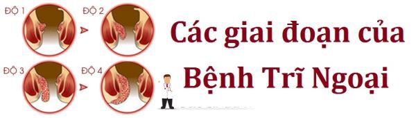 Các giai đoạn của trĩ ngoại