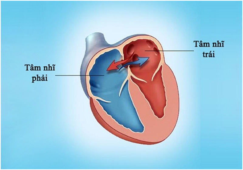 Phân loại bệnh tim bẩm sinh