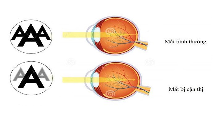 Cận thị xảy ra khi hình ảnh của một vật truyền đến mắt không nằm trên võng mạc