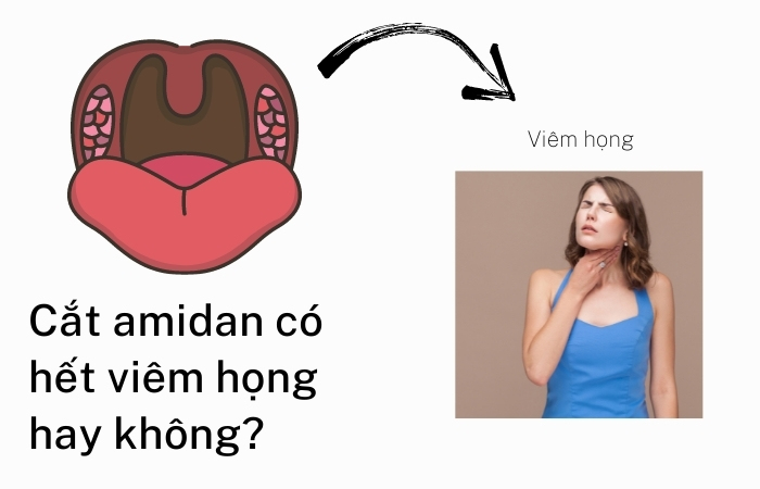 Cắt amidan có hết viêm họng không?