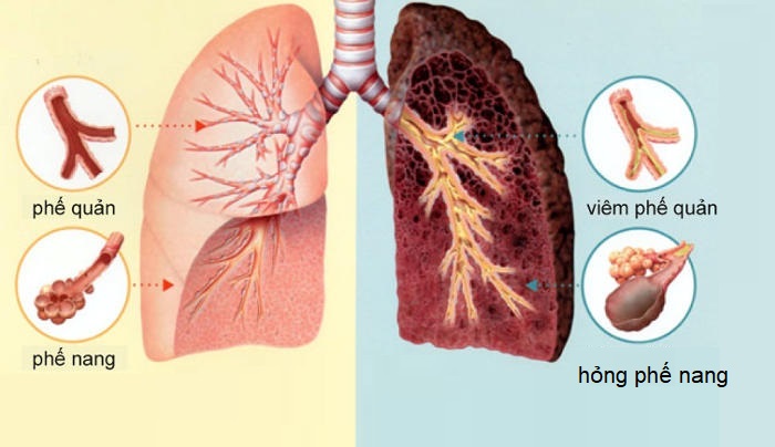 Khói thuốc ảnh hưởng nghiêm trọng đến phổi